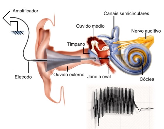 timpanometria cancun